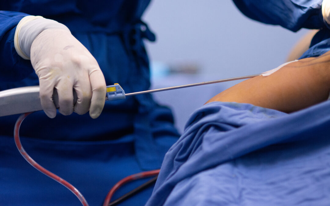 Meine erste Liposuktion – Katarina K.